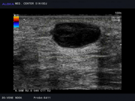 Ultrazvok žil nog - akutna tromboza vene